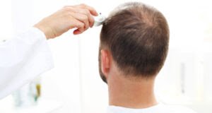 Czy DHT jest rozwiązaniem na problem z łysieniem?